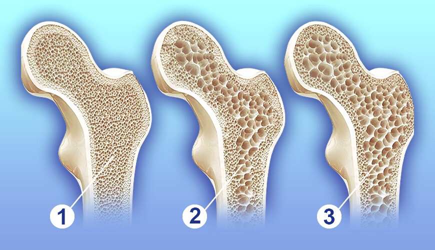 Is Osteoporosis More Common in Women?