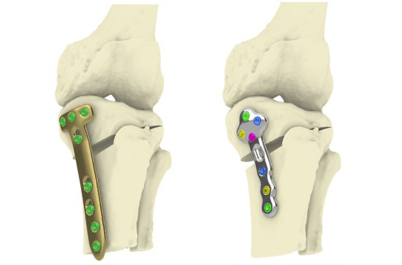 Are Orthopedic Implants Permanent?
