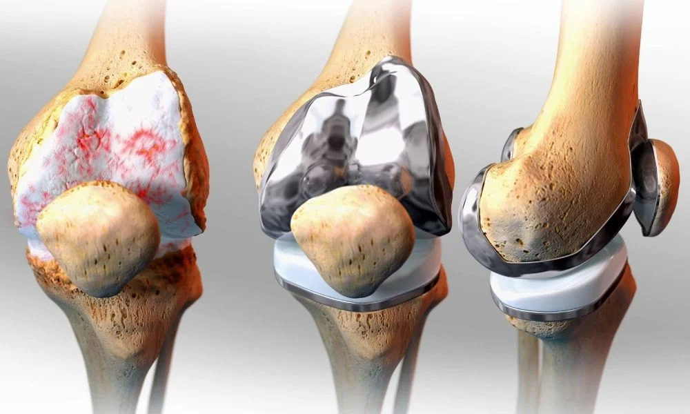 Will the Pain Completely Disappear After Knee Replacement Surgery?