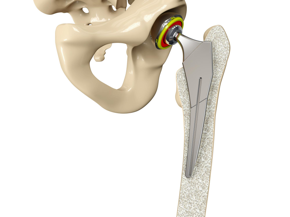 Joint Prosthesis Surgery